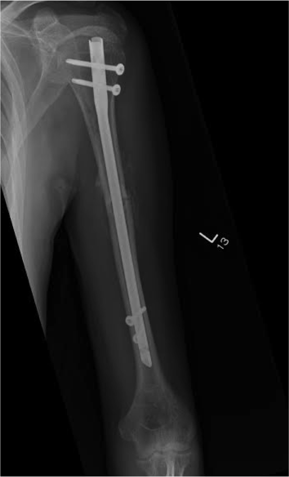 Plate Fixation Of Humeral Shaft Fractures Musculoskel Vrogue Co